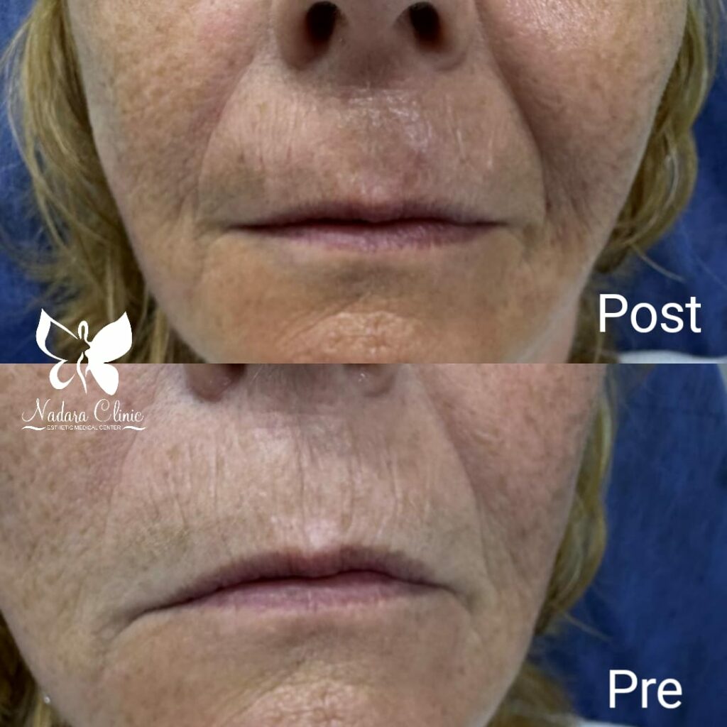 Filler for lines around the mouth and improvement from the first session